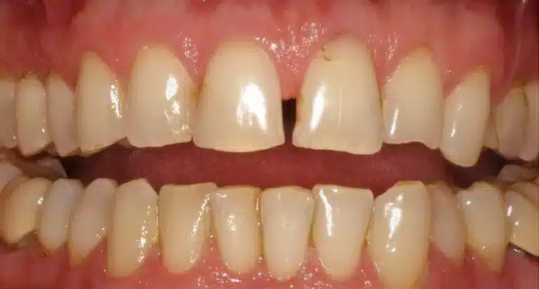 Before Image: Cosmetic Bonding Front Teeth - front