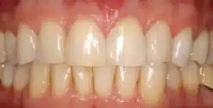 Cosmetic Bonding Front Teeth
