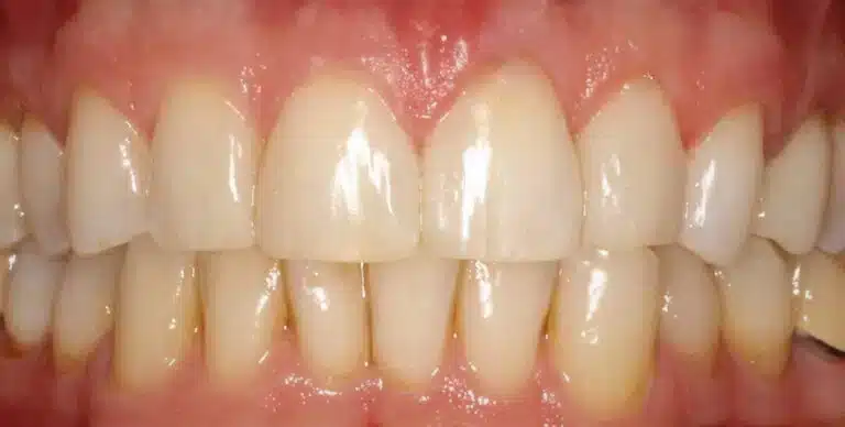After Image: Cosmetic Bonding Front Teeth - front