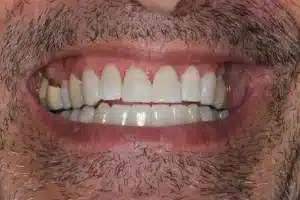 After Image: Implants & Porcelain Bridge