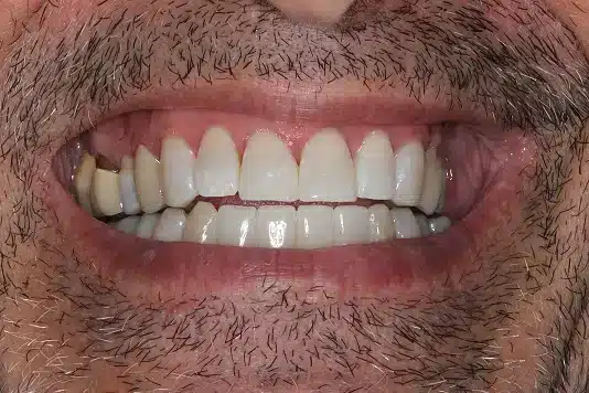 After Image: Implants & Porcelain Bridge - front