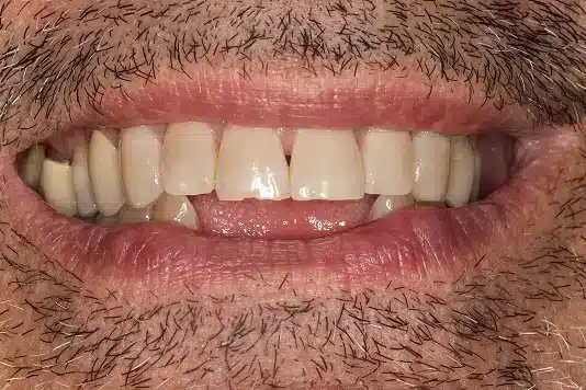 Before Image: Implants & Porcelain Bridge - front