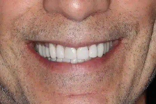 After Image: Full Mouth Reconstruction - front