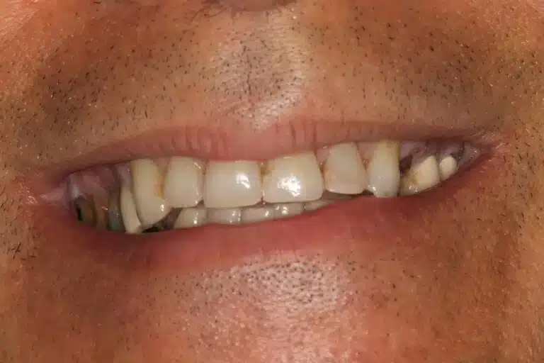 Before Image: Full Mouth Reconstruction - front