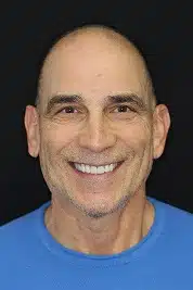After Image: Full Mouth Reconstruction - front
